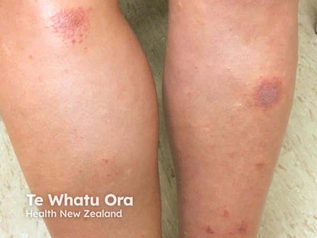 Pityriasis rosea on the limbs