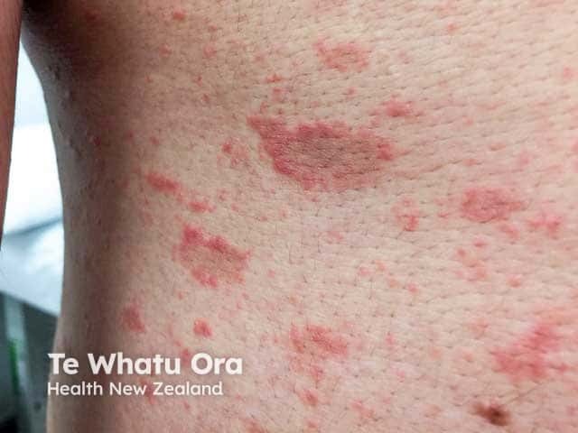 Eczematised pityriasis rosea