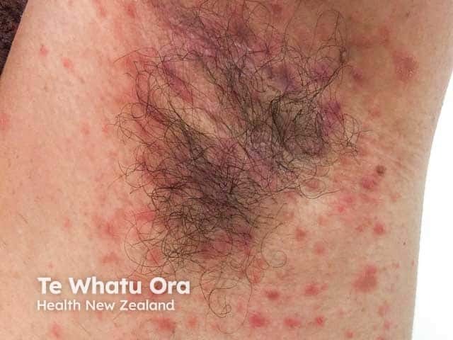 Flexural pityriasis rosea