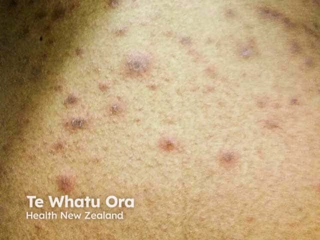 Papular lesions in pityriasis rosea