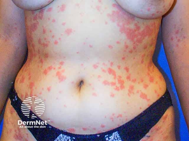 Truncal pityriasis rosea