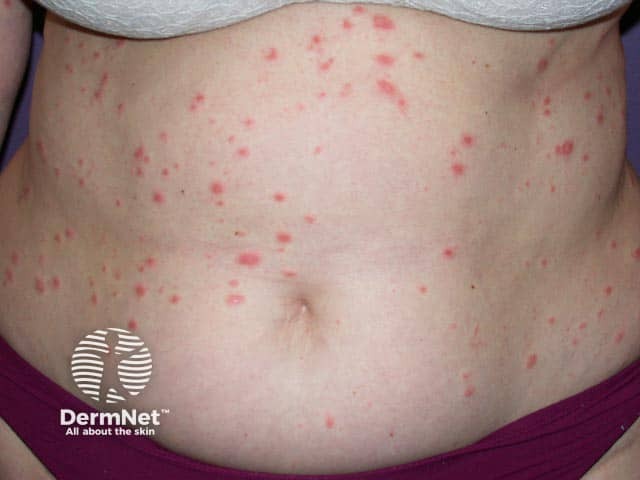 Truncal pityriasis rosea