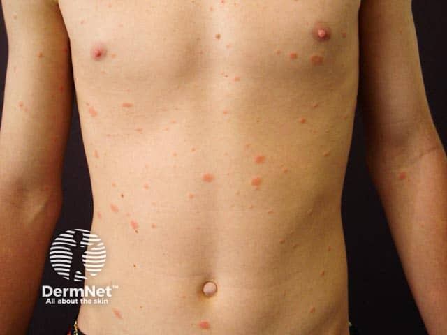 Truncal pityriasis rosea