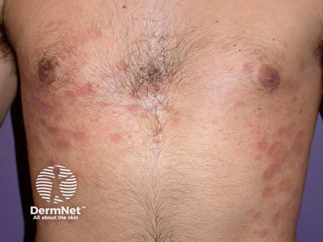 Truncal annular pityriasis rosea