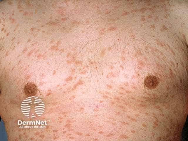 Pityriasis rosea on the chest