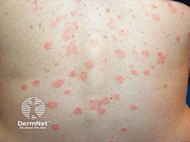 Pityriasis rosea on the back