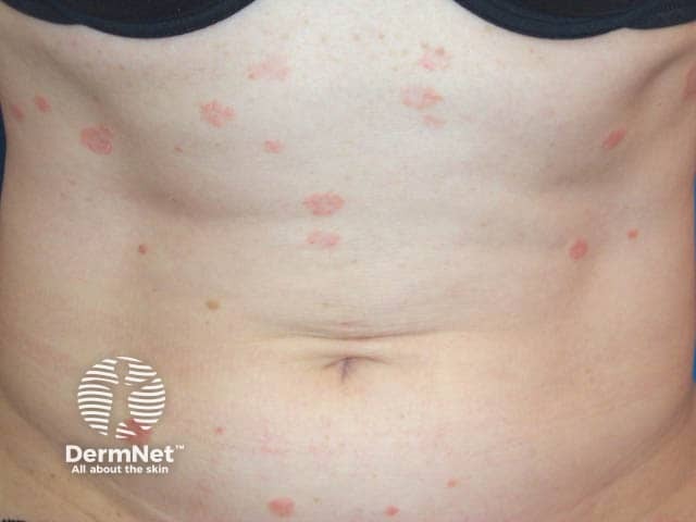 Abdominal pityriasis rosea