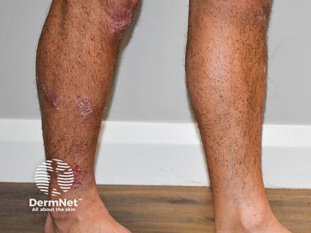 Psoriasis on the shin