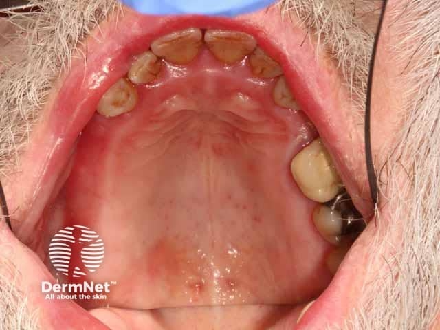 Red, glazed and oedematous changes on the gingiva and soft palate in plasma cell mucositis