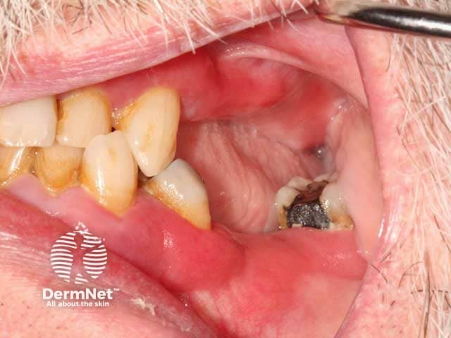 Red, glazed and oedematous changes on the gingivae in plasma cell mucositis