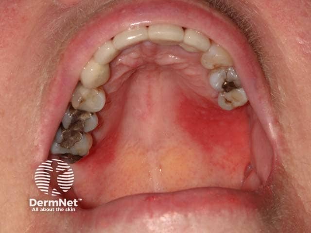 Red, glazed and oedematous changes on the hard palate in plasma cell mucositis