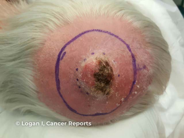 A large PDS on the scalp of a sun-damaged elderly man