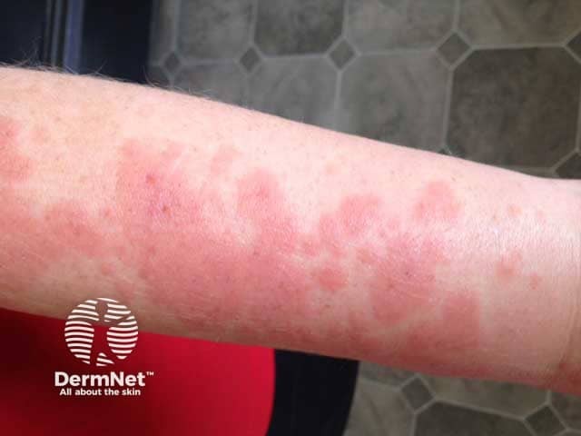 Targetoid polymorphic light eruption on recently exposed arm skin