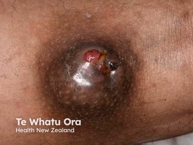 Porocarcinoma: thigh