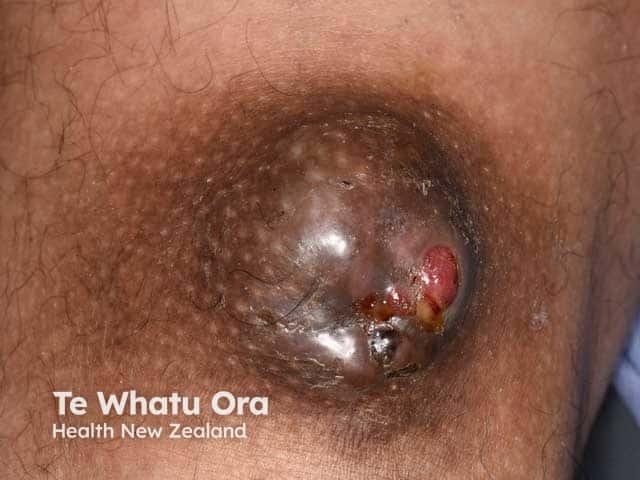 Porocarcinoma: thigh