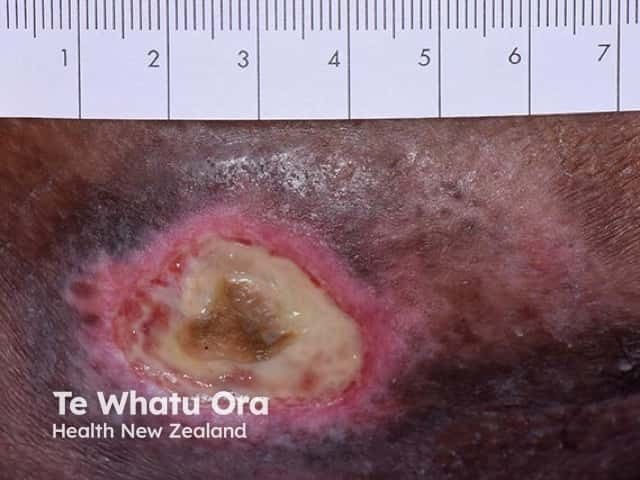 A well-circumscribed pressure ulcer with overlying slough and an underlying osteomyelitis