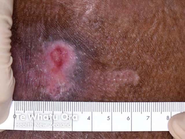 A well-circumscribed pressure ulcer where there was underlying osteomyelitis