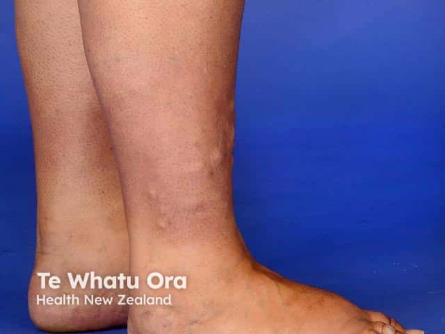 Pale nodules of pretibial myxoedema in skin of colour