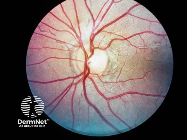 Angioid streaks extending from the fundus at 6 and 10 o'clock