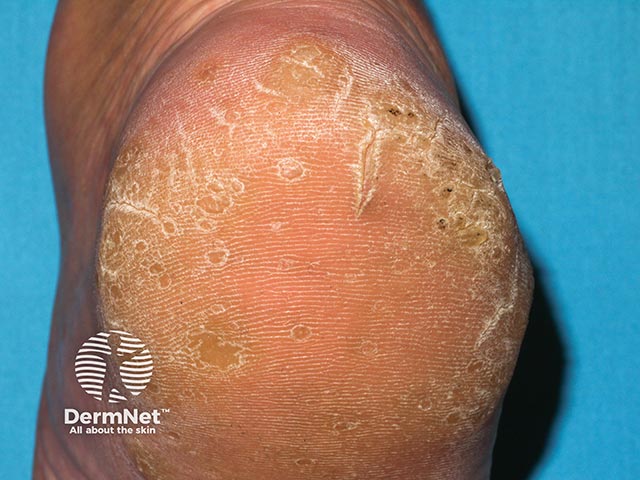 Multiple warty excrescences on the sole in hereditary punctate keratoderma