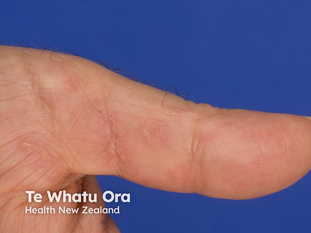 Multiple excrescences on the thumb in hereditary punctate keratoderma