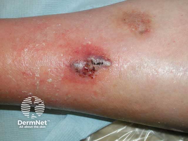 Early haemorrhagic pyoderma gangrenosum