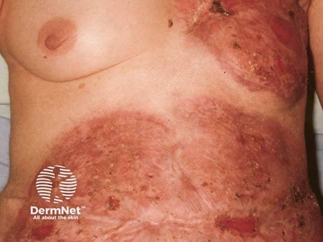 Healed post operative pyoderma gangrenosum after pulse intravenous methylprednisolone and ciclosporin