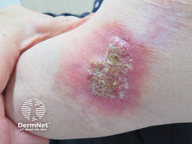 Healed pyoderma gangrenosum after intralesional steroid injection