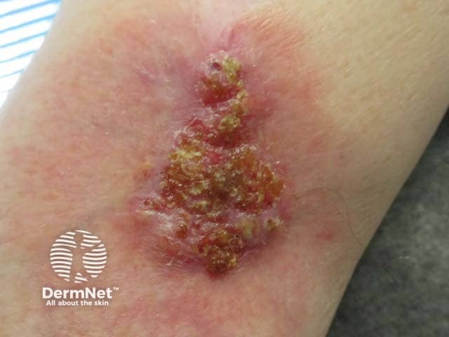 Healed pyoderma gangrenosum after intralesional steroid injection