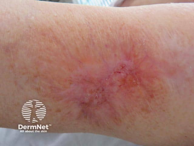 Healed pyoderma gangrenosum 12 months after intralesional steroid injection