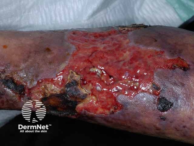 Large ulcers on the lower leg due to pyoderma gangrenosum