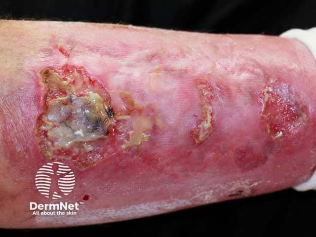 Ulcerating pyoderma gangrenosum on the lower leg