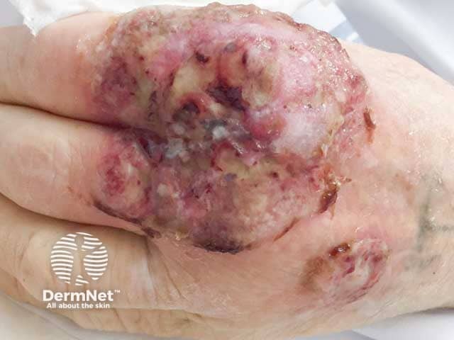 Pyoderma gangrenosum on the hand - biopsy and culture excluded malignancy and infective causes