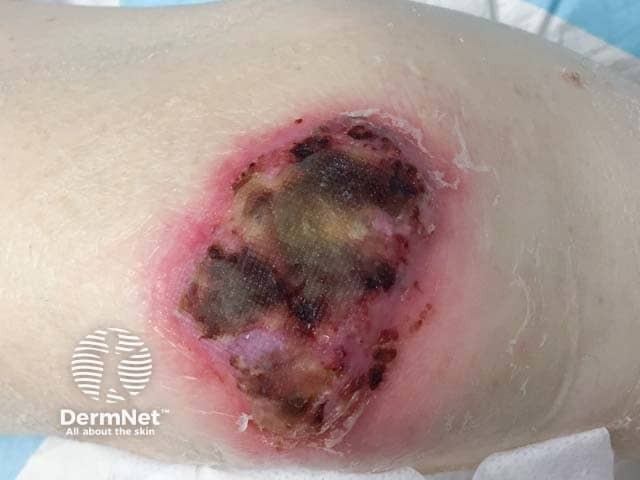 Early pyoderma gangrenosum with haemorrhagic necrotic lesions