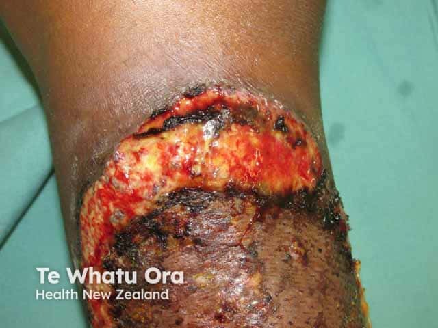 Pyoderma gangrenosum on the leg