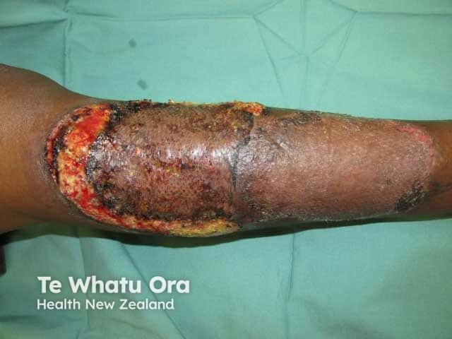 Pyoderma gangrenosum on the shin