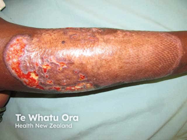 Healing shin pyoderma gangrenosum