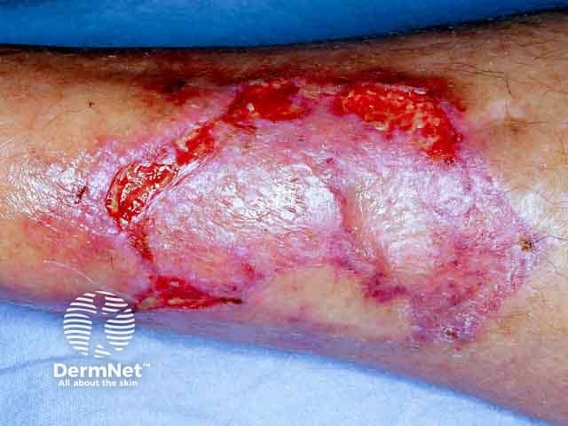 Pyoderma gangrenosum on the shin