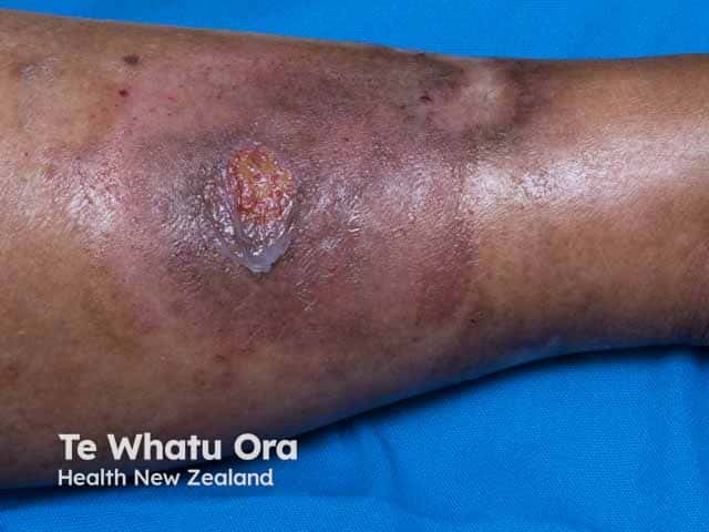 Healing pyoderma gangrenosum with post inflammatory pigmentation surrounding the small ulcers