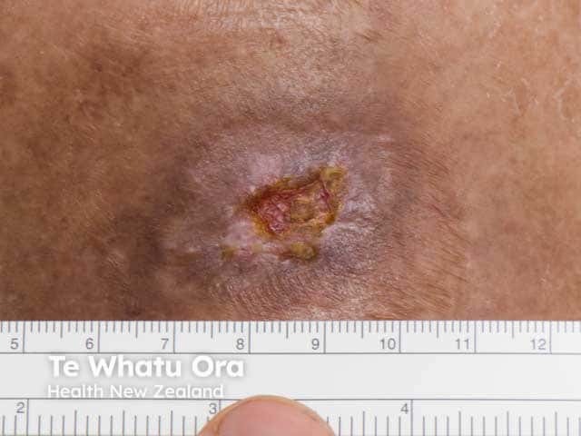 An indolent small ulcer due to pyoderma gangrenosum