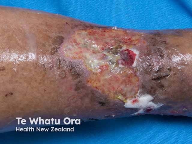 Pyoderma gangrenosum on the anterior shin