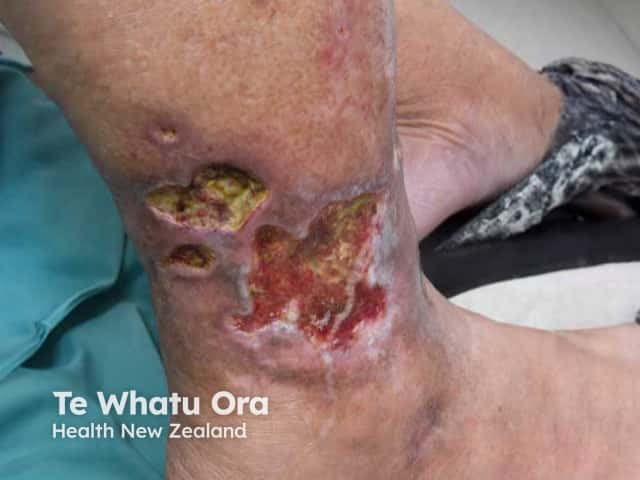 Deep lateral malleolar ulcers due to pyoderma gangrenosum