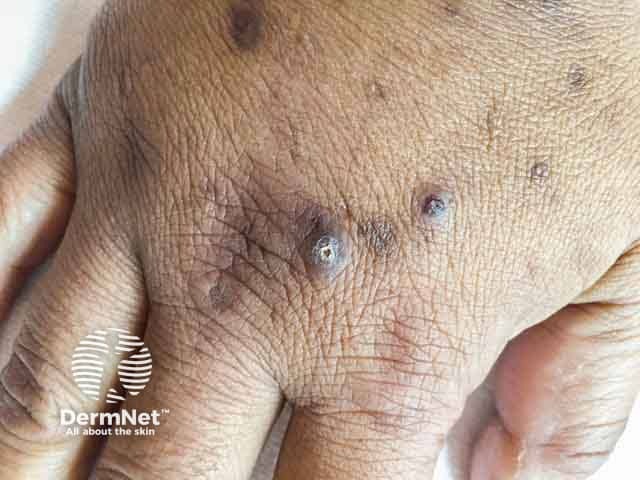 Hyperpigmented keratotic papules