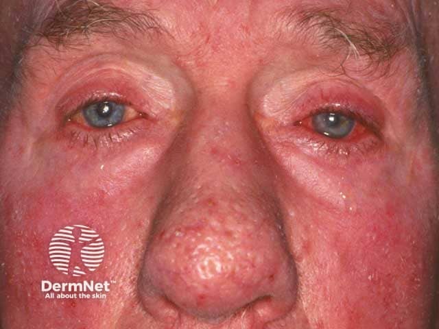 Papulopustular and ocular rosacea