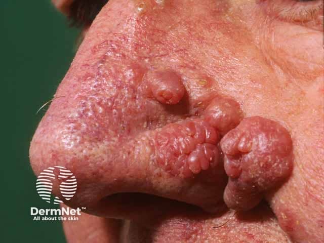 Rhinophyma