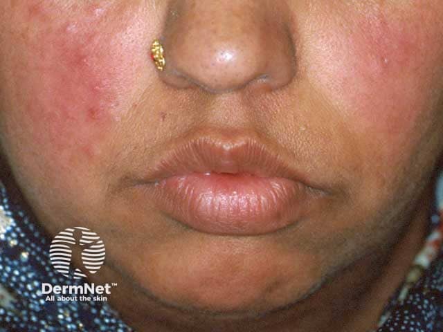 Papular rosacea on the cheeks