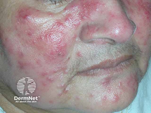 Papulopustular rosacea on the cheeks