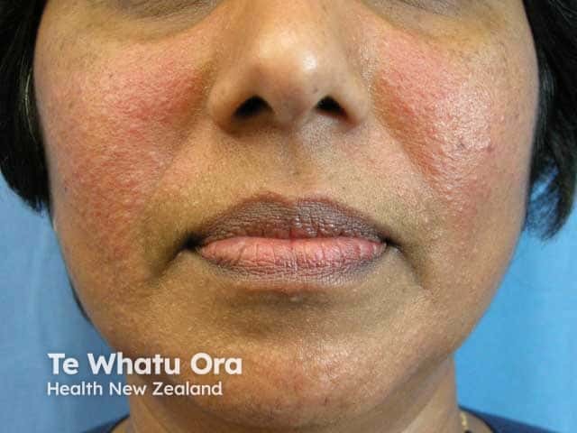 Papular rosacea on the cheeks