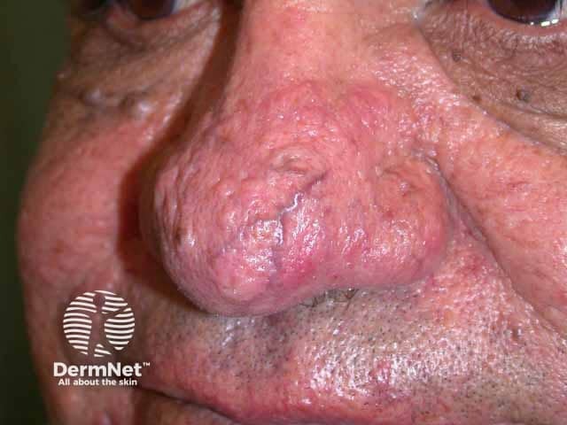 Rhinophyma