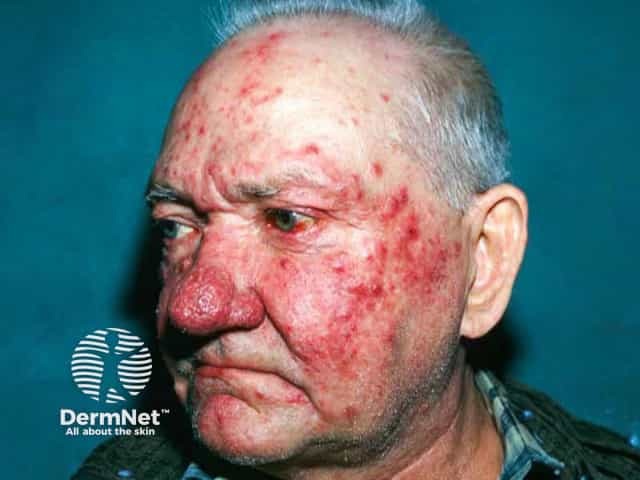 Severe papulopustular rosacea with a rhinophyma